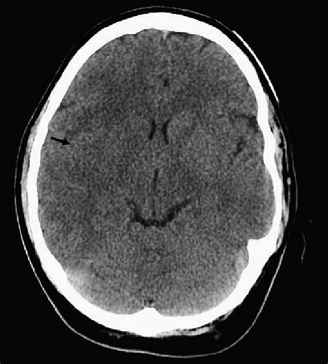 Middle cerebral artery (mca) strokes occur when the mca or its branches are occluded. Non-contrast CT showing a large acute right middle ...