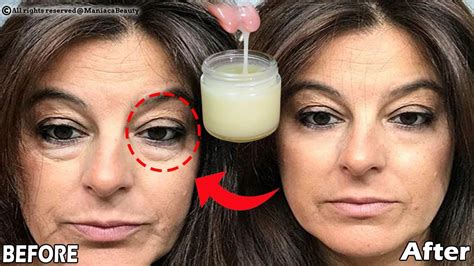 In 3 Days Get Rid Under Eye Bags Completely Remove Dark Circles Wrinkles And Puffy Eyes Youtube