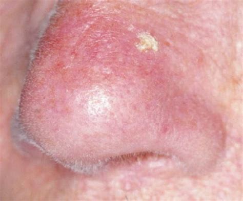 Please share your story with us! Actinic Keratosis Home Treatment