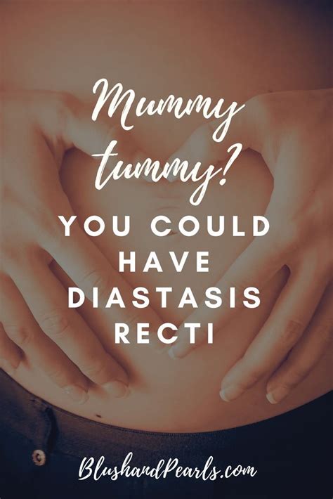 Cant Lose The Mummy Tummy You Could Have Diastasis Recti Mummy
