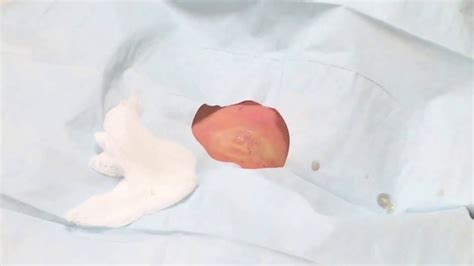 Sebaceous Pilar Cyst Removal On Back Of Neck Youtube