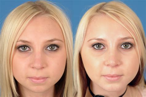 Facial Implants Before And After Photos Dr Bassichis