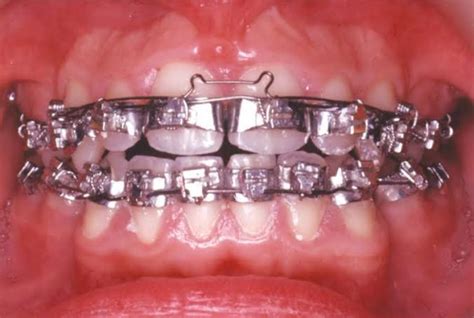 Braces From The 60s And 70s 😥 R Braces