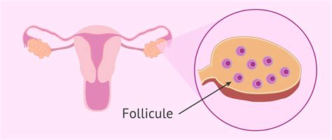 Différence entre ovaire polykystique et syndrome des ovaires polykystiques