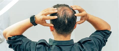 Male Pattern Baldness Treatment Options Health Centre By Manual