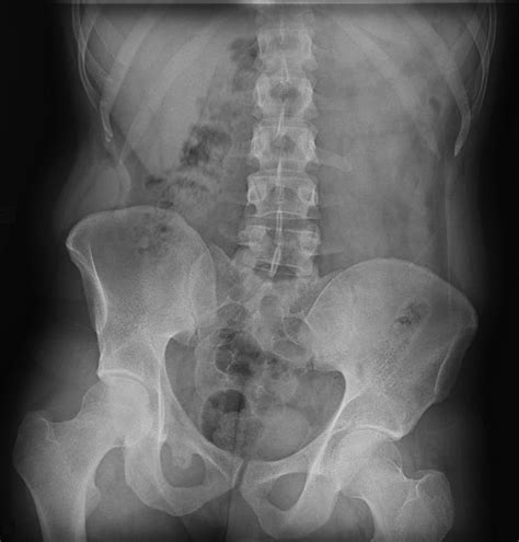 Standing Anteroposterior Lumbar Radiograph Demonstrates A Pelvic