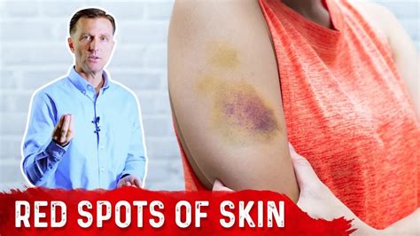 What Causes Bruises On Legs And Arms Top 5 Causes Of Bruising Covered