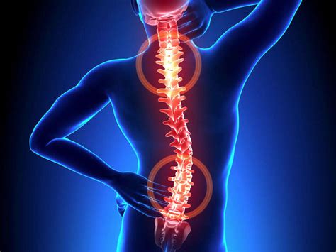 Cervical Spondylosis Cervical Spondylosis Symptoms