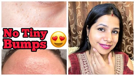 7 Days Challenge 😍 Remove Tiny Bumps Naturally In 7 Days Get