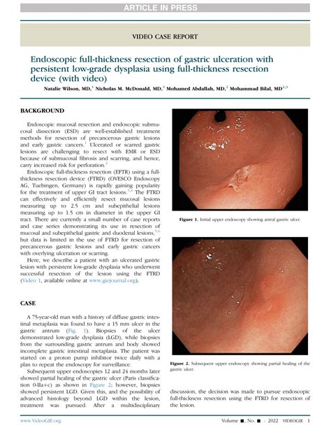 PDF Endoscopic Full Thickness Resection Of Gastric Ulceration With