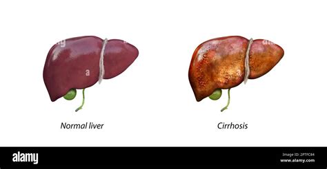 Normal Liver Versus Liver With Cirrhosis Damaged Liver Excessive