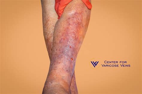 Whats The Connection Between Varicose Veins And Inflammation Center