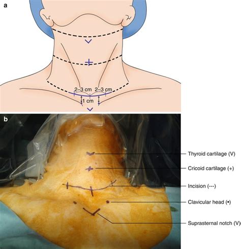 Open Thyroidectomy Springerlink