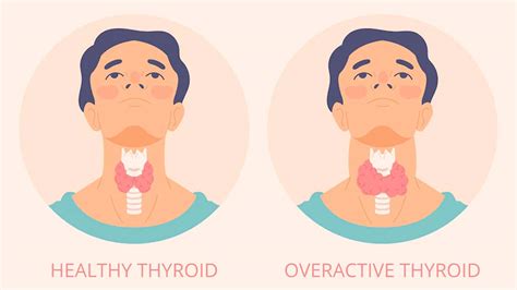 Thyroid Causes Symptoms Diagnosis And Treatment