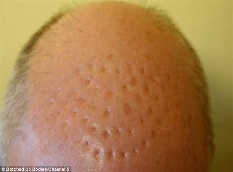 Bald Man Left With 50 Dent Like Scars On His Head After Hair Transplant
