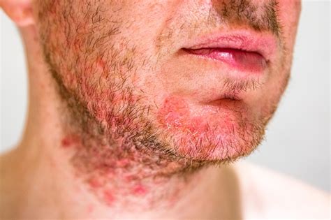 Los Tipos De Dermatitis Y Sus Caracter Sticas