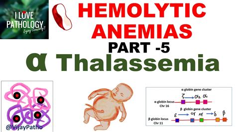 Hemolytic Anemias Part 5 Alpha Thalassemia Pathogenesis Types
