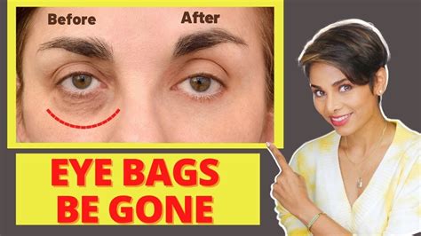 Share More Than 90 Remedy For Eye Bags In Cdgdbentre