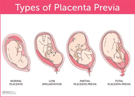 Placenta Previa Nursing Care Plan And Management