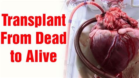 3rd December First Human Heart Transplant Bolopakistan