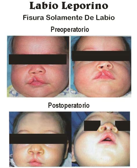 Sintético 98 Foto Niños Con Labio Leporino Antes Y Después Mirada Tensa