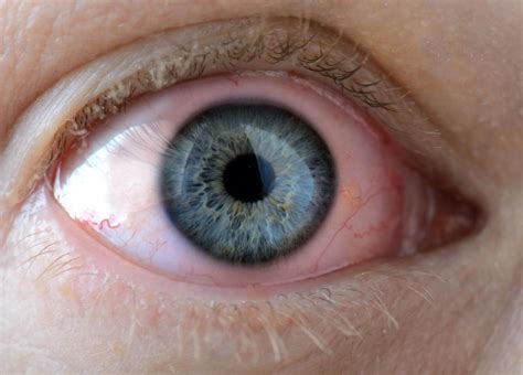 What Are The Symptoms Of A Chlamydia Eye Infection