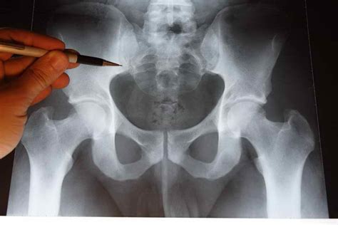 Osteopatía De Pubis