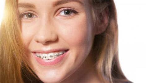 How Much Do Braces Cost North Ryde Dentistry