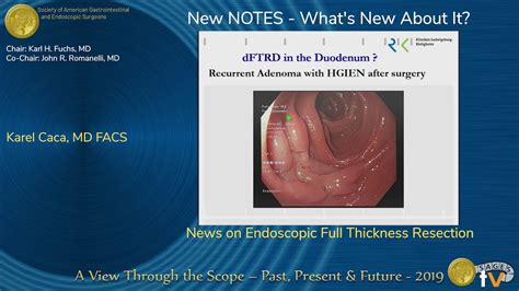 News On Endoscopic Full Thickness Resection YouTube