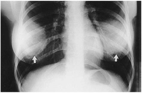 Radiographic Artifacts Radiology Key