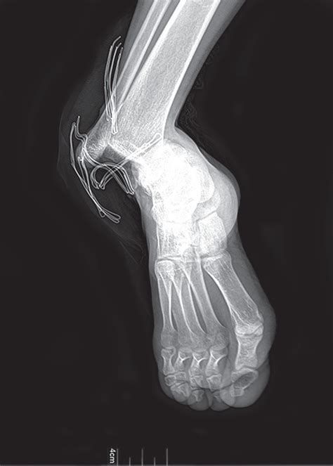 Dislocated Ankle X Ray