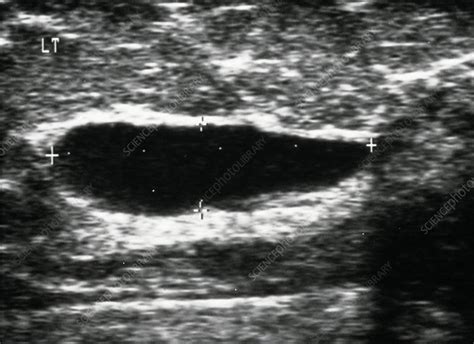 Ultrasound Image Of A Female Breast Showing A Cyst Stock Image M122