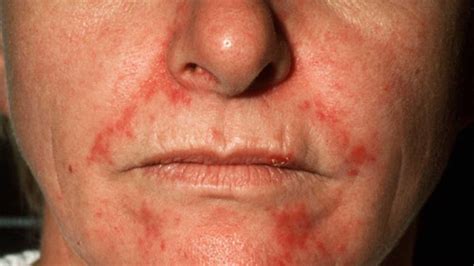 Seborrheic Dermatitis On Face Treatment Symptoms And Pictures