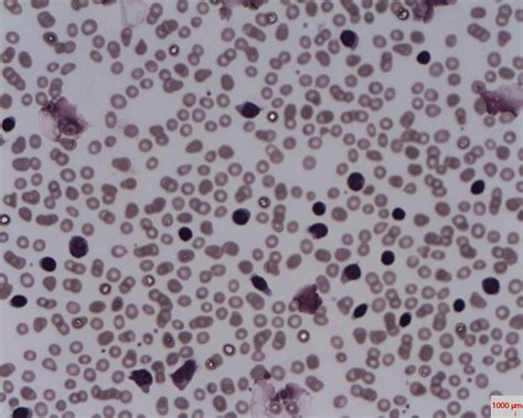 White Blood Cell Inclusions And Abnormalities Hematology
