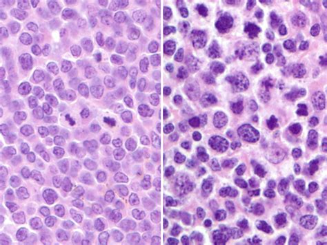Mantle Cell Lymphoma Oncohema Key