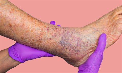 Why Early Evaluation Helps You To Avoid Serious Varicose Vein Risks