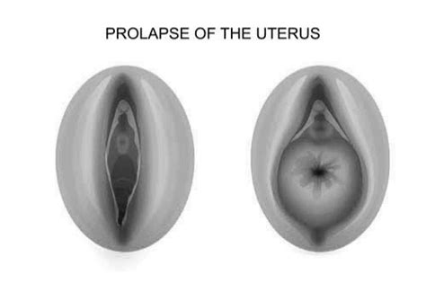 Sign And Symptoms Of Prolapse Uterus Pt Master Guide