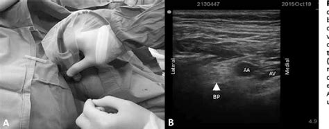 Figure 4 From Ultrasound Guided Costoclavicular Approach