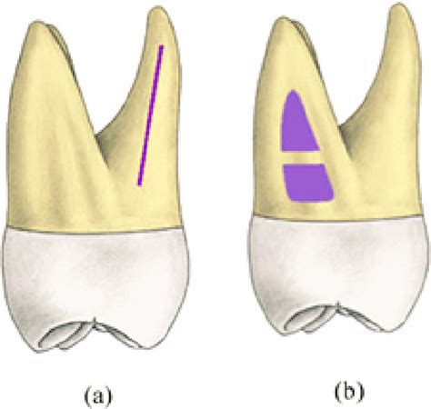 Mesial Aspect Of Maxillary Second Molar Roots Reprinted From 3d Tooth
