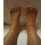Bilateral Ankle Edema Causes When Tests Are Normal » Scary Symptoms