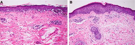 A Skin Biopsy Histology Before Treatment Shows Melanoma In Situ Nests