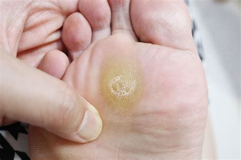 See full list on mayoclinic.org Calluses and Corns | Sutherland Podiatry Centre