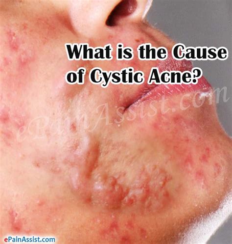 What Is The Cause Of Cystic Acne And How To Get Rid Of It