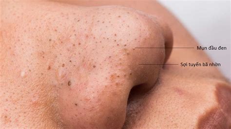 Sebaceous Filaments Treatment How Its Different From Blackheads