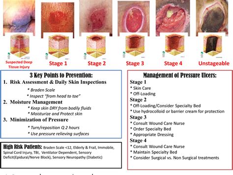 Stage 4 Pressure Ulcer Treatment