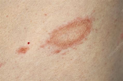 Herald Patch Pityriasis Rosea Causes Pagballs
