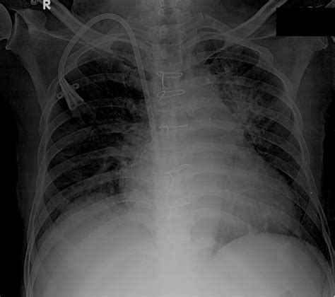 Peritoneal Dialysis Catheter X Ray