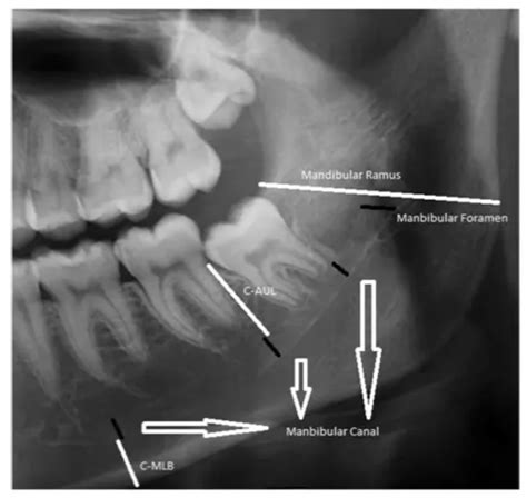 Aesthetic And Medical Overview Of Jaw Recession Qoves