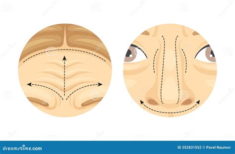 Plastic Surgery As Restoration And Reconstruction Of Human Forehead And