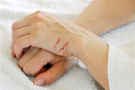 Everything You Need To Know About Cat-Scratch Disease